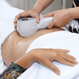 Giảm mở bụng Mita beauty